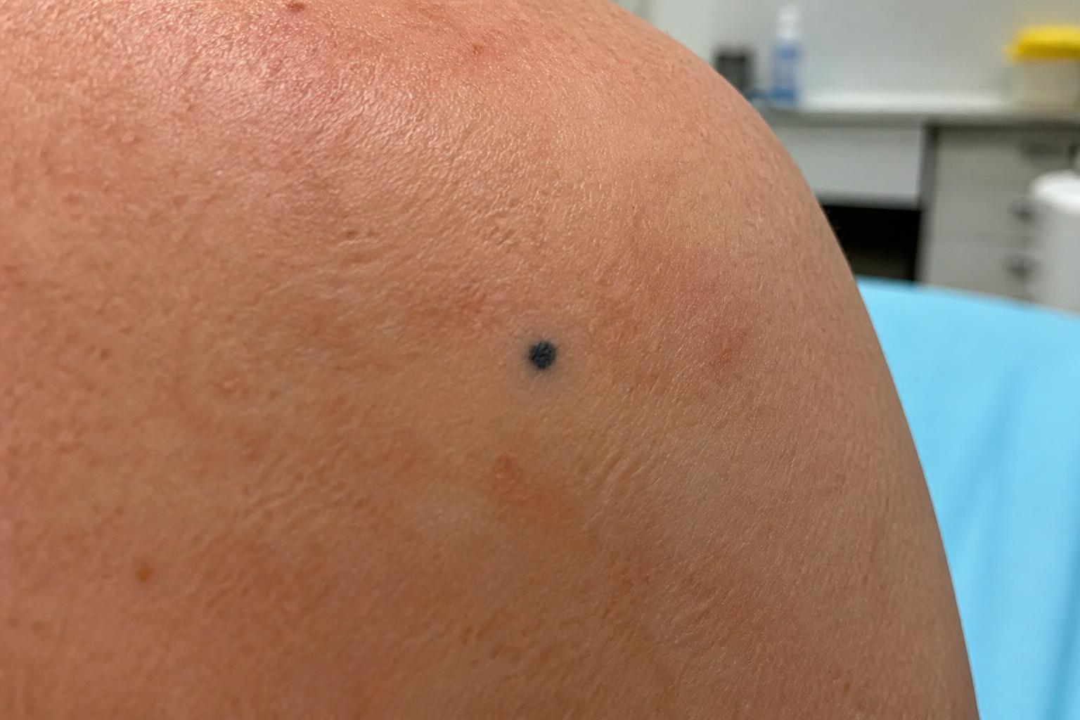 Tatouage et marquage avant radiothérapie : tout savoir pour mieux préparer votre traitement 2 découvrez tout ce qu'il faut savoir sur les tatouages et marquages avant une radiothérapie pour bien préparer votre traitement et optimiser son efficacité.